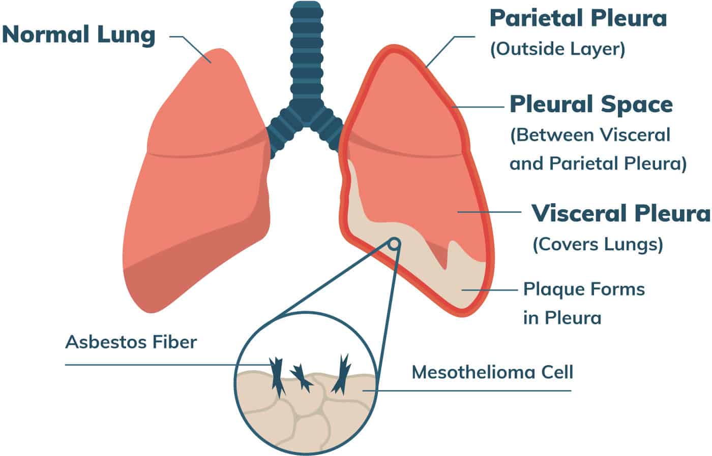 Myths and Misconceptions about Mesothelioma blog picture